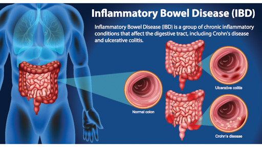 IBD CROHNS & COLITIS 